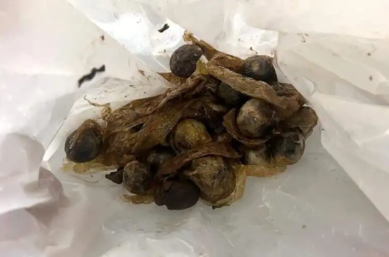 Հռոմէն Երեւան հասած քաղաքացիին ստամոքսէն հանուած է մեծ քանակութեամբ թմրանիւթ (Տեսանիւթ)